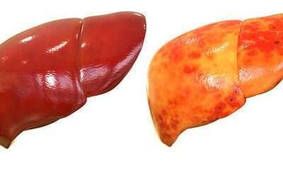 Why it is important not to neglect a fatty liver.