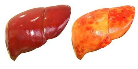 fatty liver